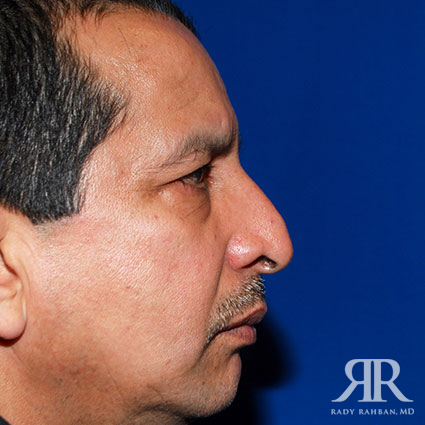 Rhinoplasty w/ Chin Implant