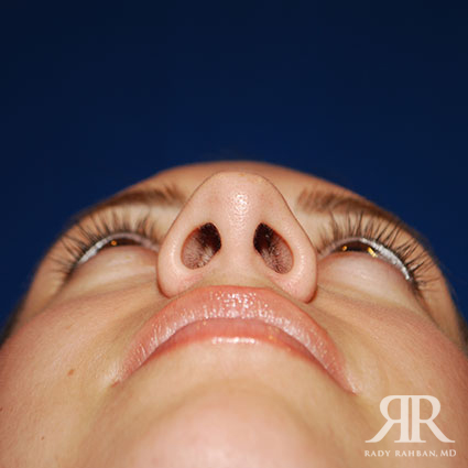 Rhinoplasty w/ Chin Implant