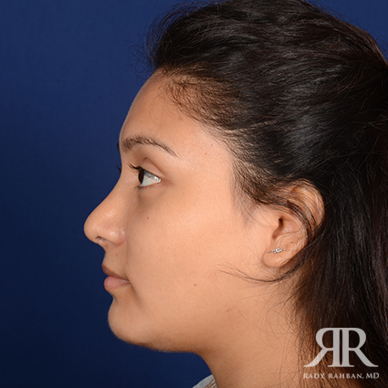 Rhinoplasty w/ Chin Implant
