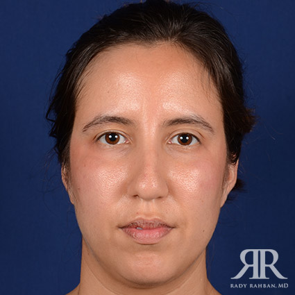 Rhinoplasty w/ Chin Implant