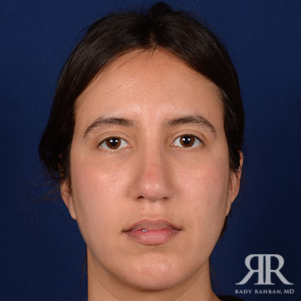 Rhinoplasty w/ Chin Implant