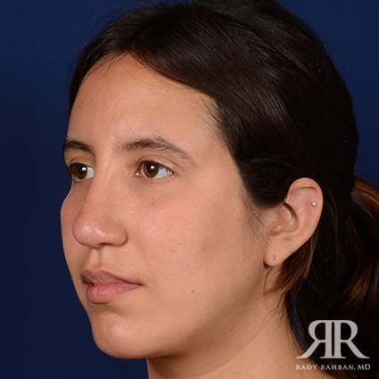 Rhinoplasty w/ Chin Implant