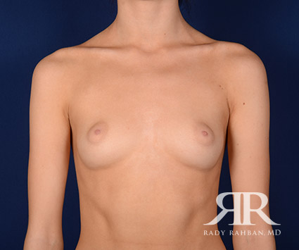 Before Breast Augmentation After Breastfeeding