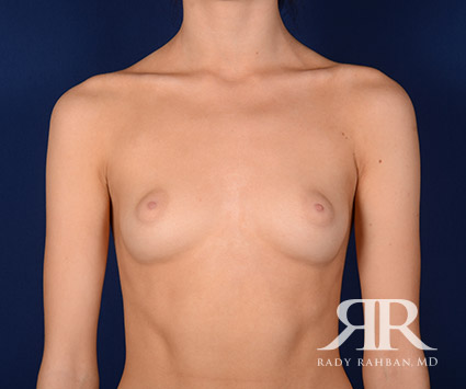 Breast Augmentation