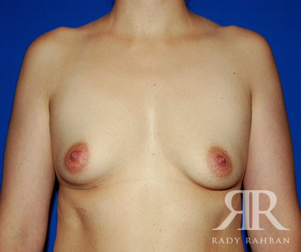 Breast Augmentation