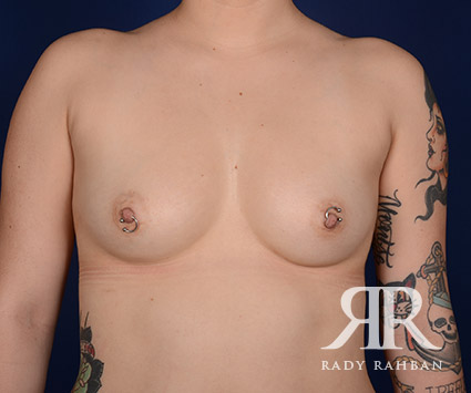 Breast Augmentation