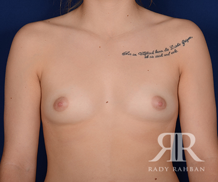 Breast Augmentation