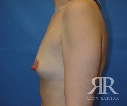 Breast Augmentation