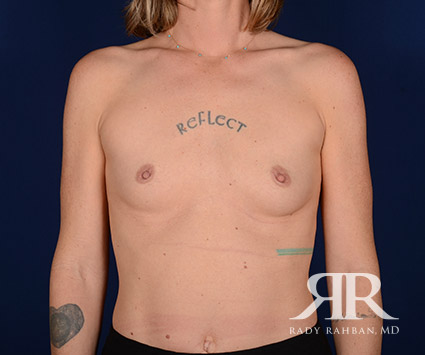 Breast Augmentation