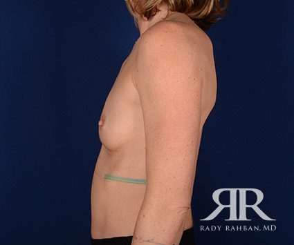 Breast Augmentation