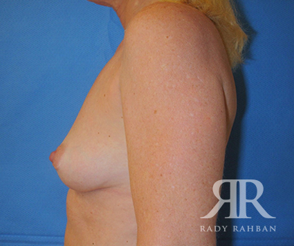 Breast Augmentation