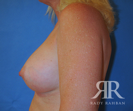 Breast Augmentation