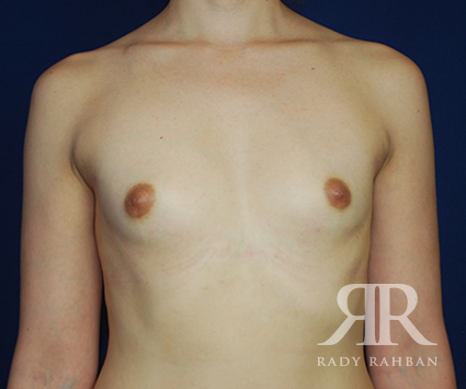 Breast Augmentation