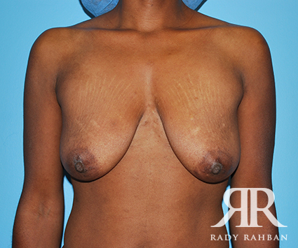 Breast Lift After Pregnancy