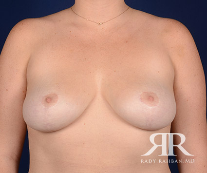 Breast Reduction