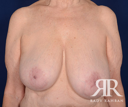 Breast Reduction