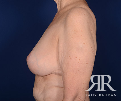 Breast Reduction