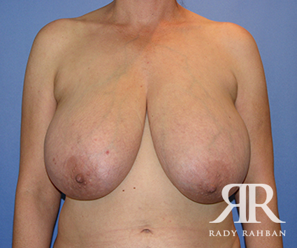 Breast Reduction