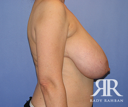 Breast Reduction