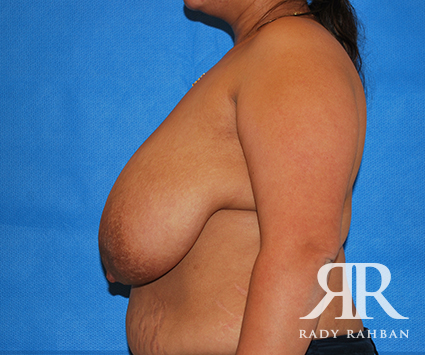 Breast Reduction