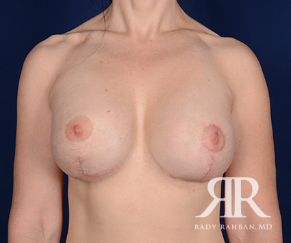 Corrective Breast Surgery