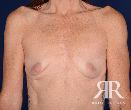 Corrective Breast Surgery