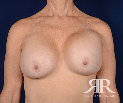 Corrective Breast Surgery