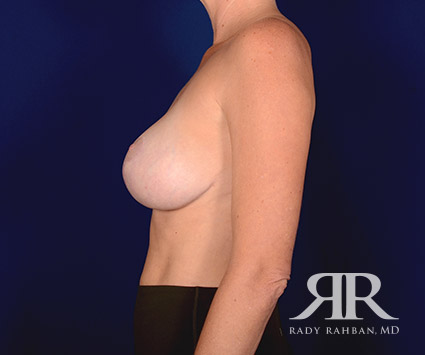 Corrective Breast Surgery