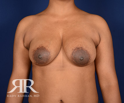 Corrective Breast Surgery