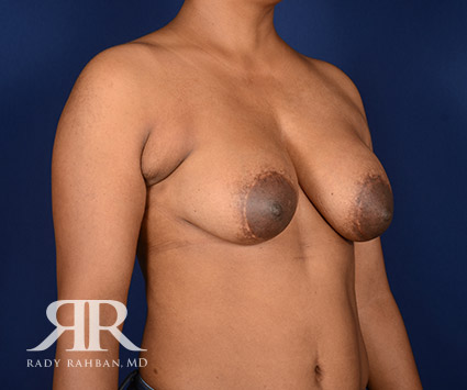 Corrective Breast Surgery