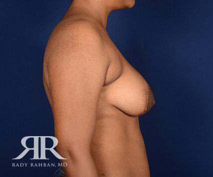 Corrective Breast Surgery