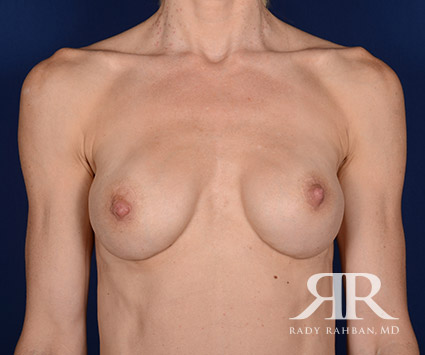 Corrective Breast Surgery