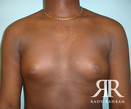 Male Breast Reduction
