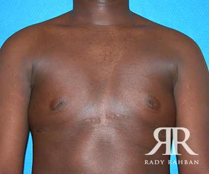 Male Breast Reduction