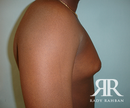 Male Breast Reduction