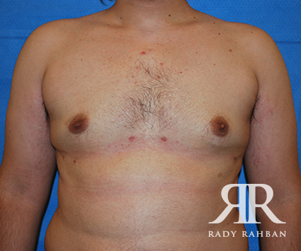 Male Breast Reduction