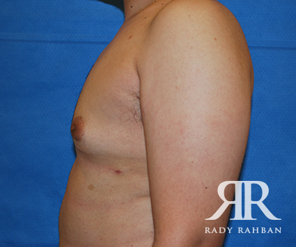 Male Breast Reduction