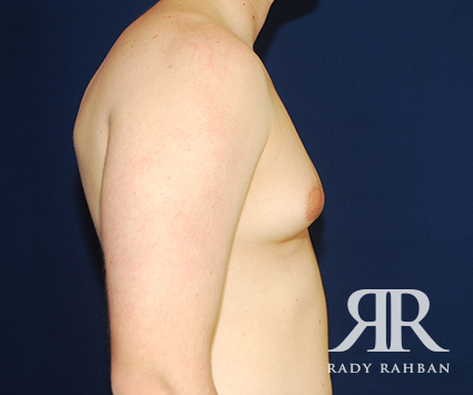 Male Breast Reduction