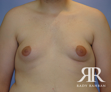 Male Breast Reduction