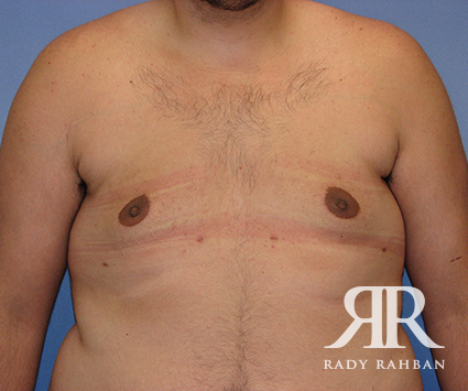 Male Breast Reduction Befoe & After Photo 03