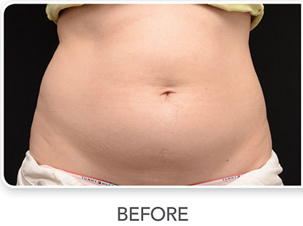 CoolSculpting