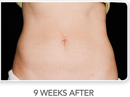 CoolSculpting Before & After Photo 01