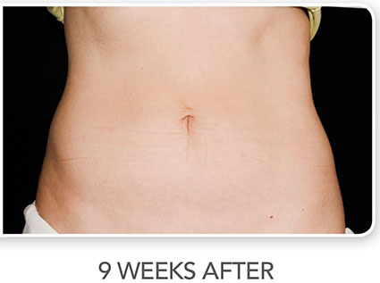 CoolSculpting