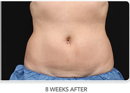 CoolSculpting Before & After Photo 02