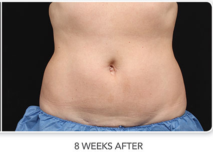 CoolSculpting