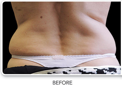 CoolSculpting