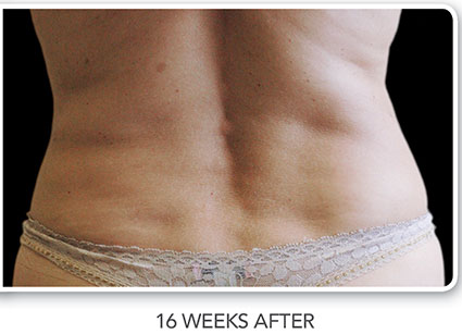 CoolSculpting Before & After Photo 03