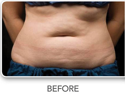 CoolSculpting