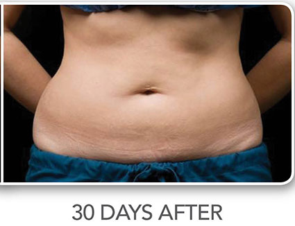 CoolSculpting