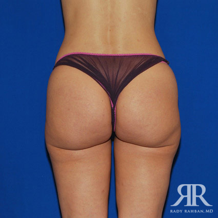 Liposuction